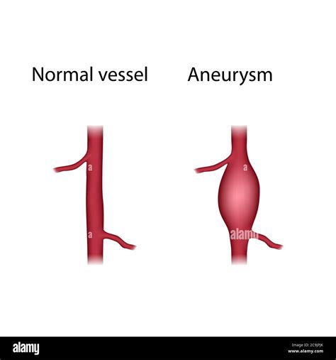 Normal Vessel And Aneurysm Comparison Illustration An Aneurysm Is A