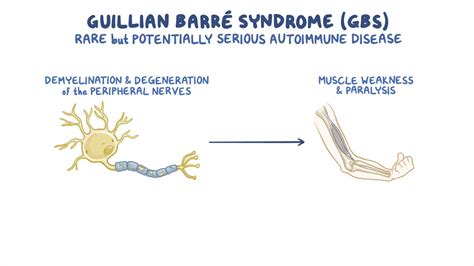 Guillain Barre Syndrome Neuron