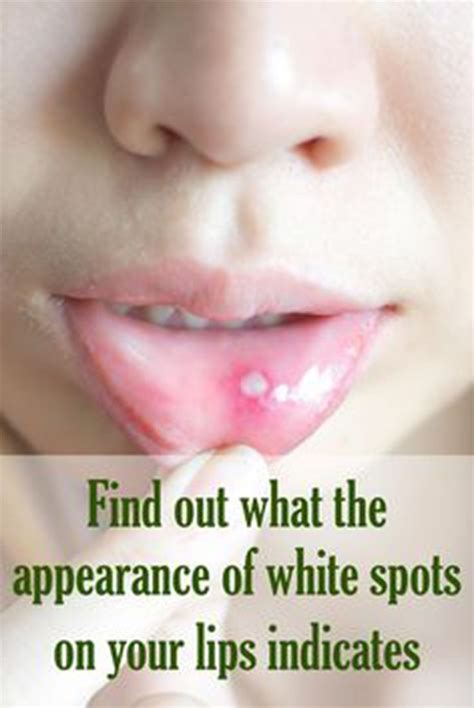 How To Get Rid Of Fordyce Spots On Shaft At Home Wiki Hows