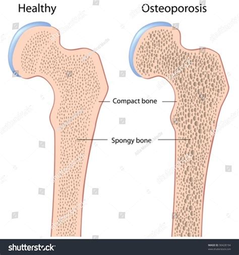 Femur Bone Of Hip Anatomy Normal And With Osteoporosis Stock Vector