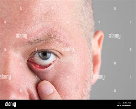 Enfermedad Ocular Dolorosa Fotografías E Imágenes De Alta Resolución Alamy