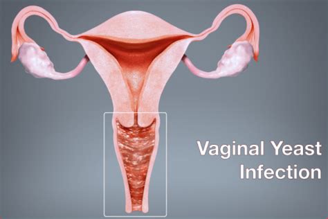 Vaginal Candidiasis And The Most Common Yeast Infection In Women Greener Health