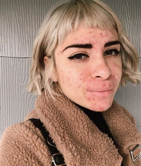 10 Inspiring Images That Prove Acne Is Not Ugly Girl With Acne Girl