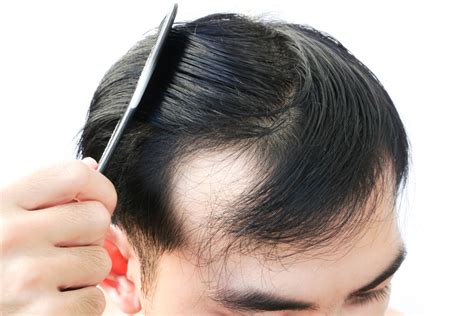 How To Stop Early Stages Of Baldness And Thinning Hair ~ The Male Grooming Review
