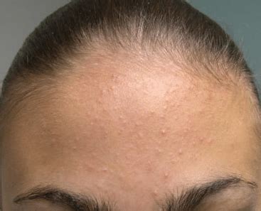 Heat rash is also called miliaria rubra, miliaria crystallina, summer rash or prickly heat. Heat Bumps, on Face, Forehead, Rash, Itchy, Get Rid ...