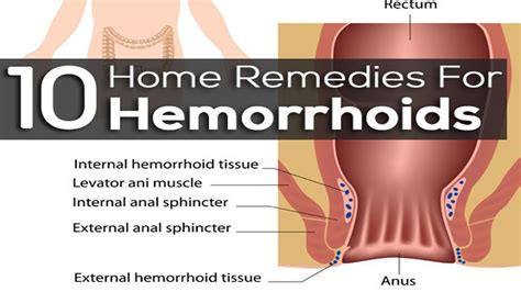 Symptoms What Does Piles Look Like Symptoms Of Disease