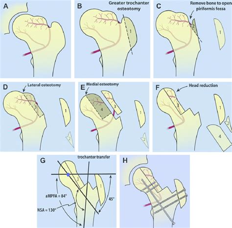 Femoral Head Reduction Osteotomy Fhro Technique A Coxa Magna With