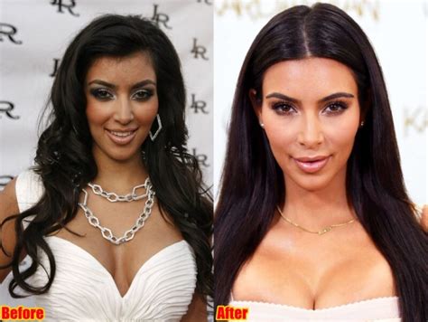 Kim Kardashian Plastic Surgery Journey Before And After 2023