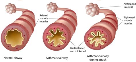 How Does Asthma Impact The Respiratory System