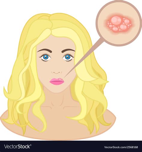 Cold Sores On Childs Face Clipart