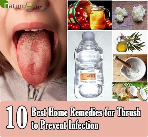 10 Best Home Remedies For Thrush To Prevent Infection Home Remedies