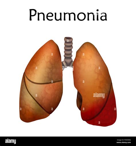 La Neumonía La Ilustración Una Condición Inflamatoria Del Pulmón