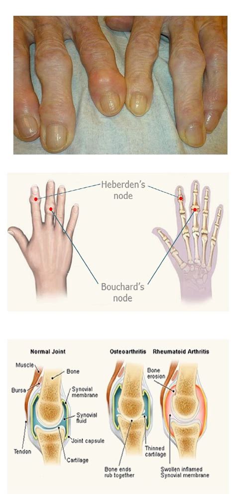 Heberdens Nodes Images Osteoarthritis Bone And Joint Synovial Fluid