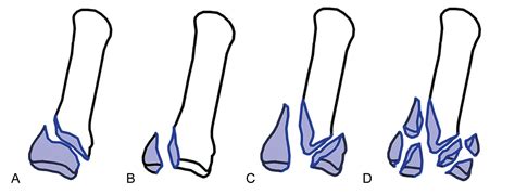New guide because a lot. Orthoforum Fraktur Os metacarpale
