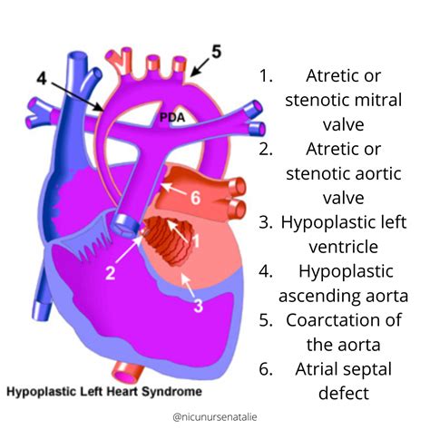 Hypoplastic Left Heart Syndrome Hlhs — The Nurse Natalie