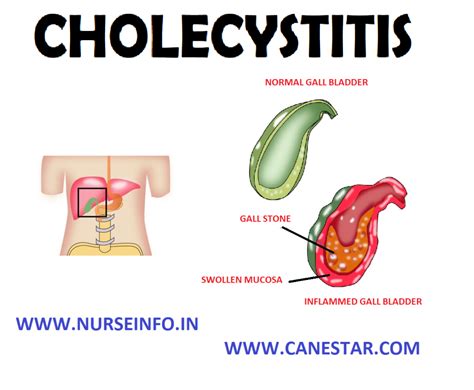 Cholecystitis Nurse Info