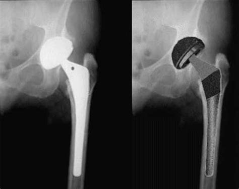 Hip Joint Replacement Surgery Cemented Uncemented Artificial