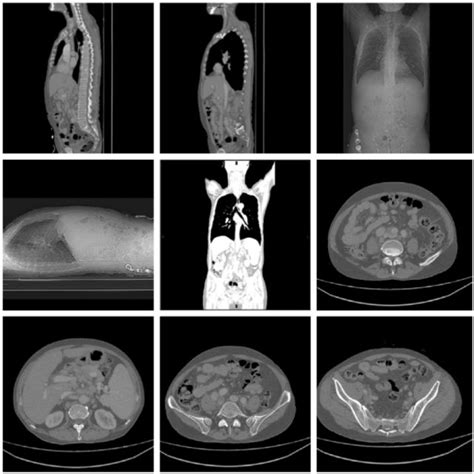 Computerized Tomography Ct Scan Of The Chest And Abdomen With