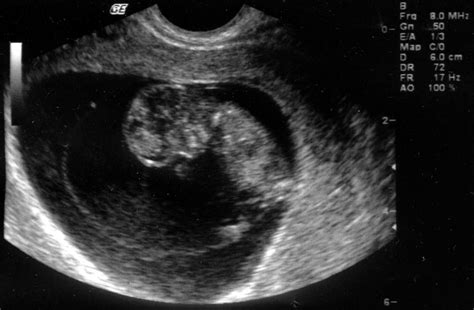 10 Weeks Pregnant Preg Med