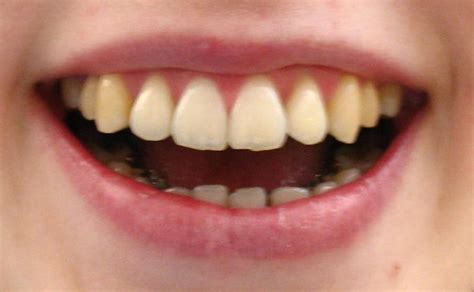 Eine der gängigsten methoden, zähne zu begradigen, ist die behandlung mit festsitzenden zahnspangen, die kosten für eine zahnspange für erwachsene. Feste Zahnspange beim Kieferorthopäden in Bonn