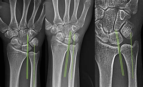 Radiological Degenerative Changes In The Distal Radioulnar Joint After