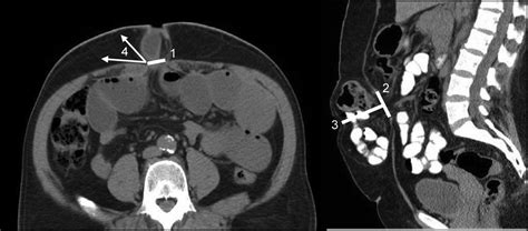 Computed Tomography Findings Associated With The Risk For Emergency