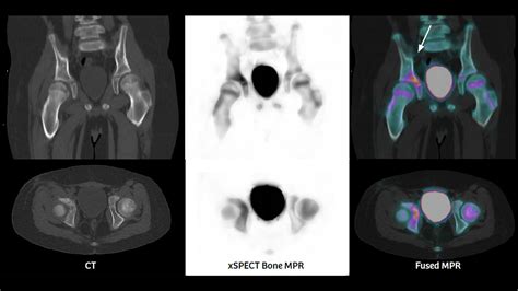 Differentiation Of A Rib Benign Lesion From A Metastasis Using Xspect Quant