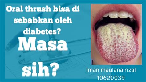 Oral Thrush Manifestasi Penyakit Sistemik Diabetes Militus Dm Youtube