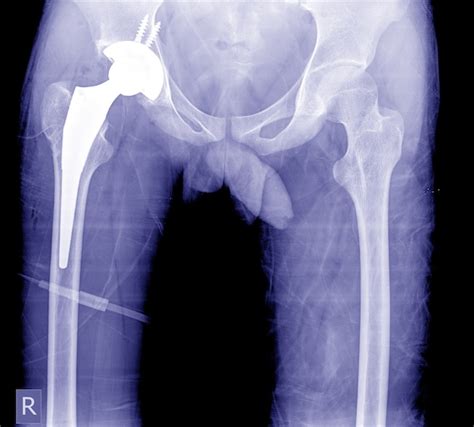 Premium Photo Total Hip Arthroplasty X Ray Image Very Good Quality Show Post Operation At Hip