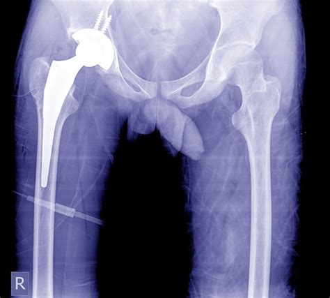 Premium Photo Total Hip Arthroplasty X Ray Image Very Good Quality