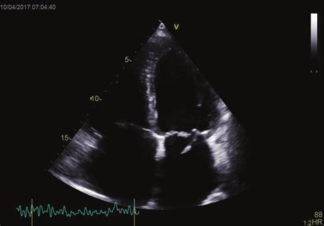 Endocarditis Of The Mitral Valve And Ruptured Mitral Chordae