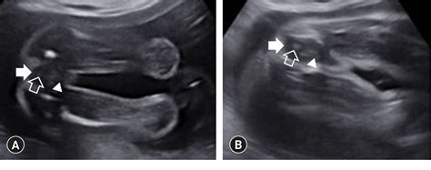 Figure 1 From The Diagnosis Of An Imperforate Anus In Female Fetuses
