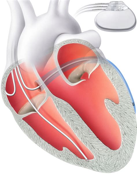 Cardiac Resynchronization Therapy Crt