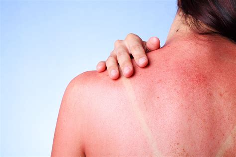 5 Ways To Treat Sun Poisoning