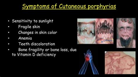 Porphyria The Vampire Disease