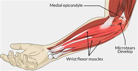A Helpful Guide To Push Ups Elbow Pain