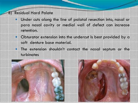Ppt Restoration Of Acquired Defects Of Hard Palate In Dentate