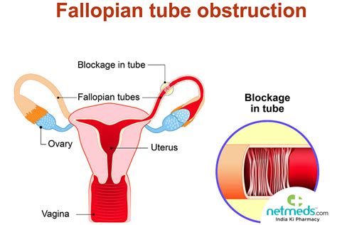 Fallopian Tube Cancer Causes Symptoms And Treatment