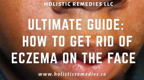 Ultimate Guide How To Get Rid Of Eczema On The Face Infographic Holistic Remedies Llc