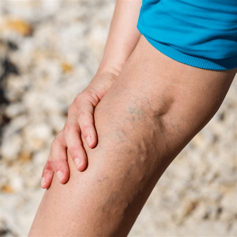 Pain Relief Options For Varicose Veins Delaware Vein Center