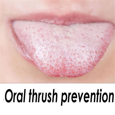 Oral Thrush Natural Treatment For Oral Thrush