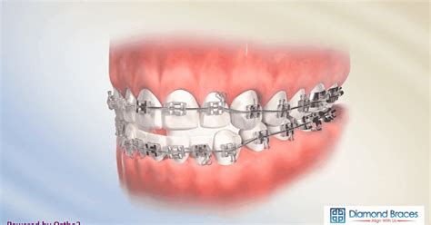 How To Tell If You Need Braces Test When You Know That You Need