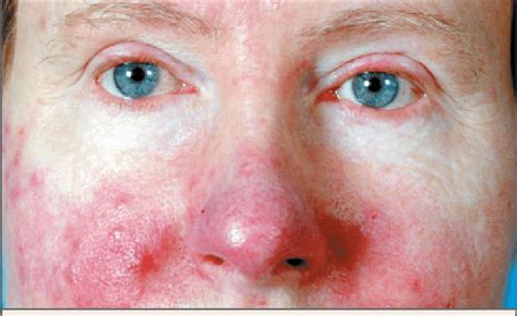 Papulopustular Subtype 2 And Ocular Subtype 4 Rosacea Of Moderate