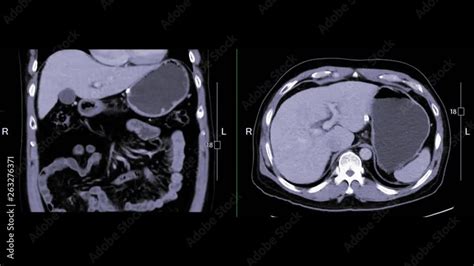 Ct Upper Abdomen Comparison Coronal And Axial View Showing Small Liver