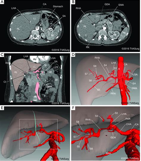 Hepatic Arterial Anatomy A Axial Ct Image Of Patients Abdominal