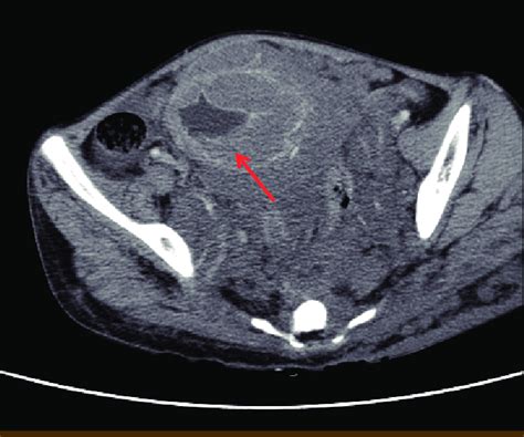 Abdomino Pelvic Ct Scan Shows A Bulky Hypodense Tumor Measuring About