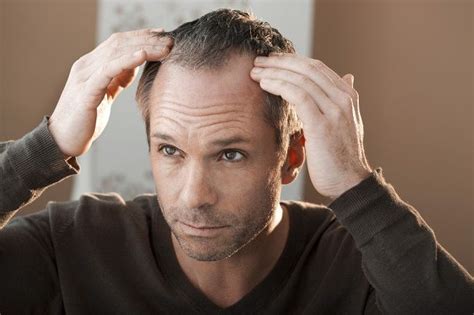 Common Male Hair Loss Causes Hair Loss Men Reverse Hair Loss Hair