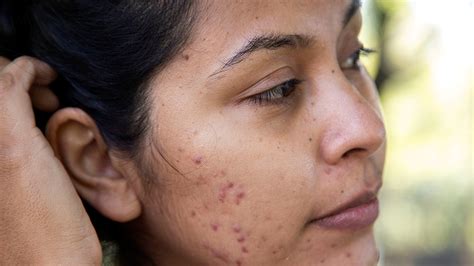 Acne Dark Spots On Face