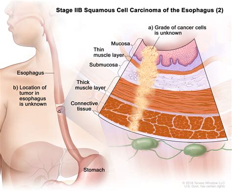 Esophageal Cancer Vanderbilt Ingram Cancer Center