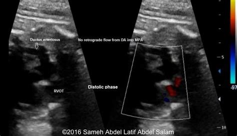 📃 Pulmonary Valve Stenosis